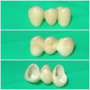 Tandbro / tandbrygga från olika håll